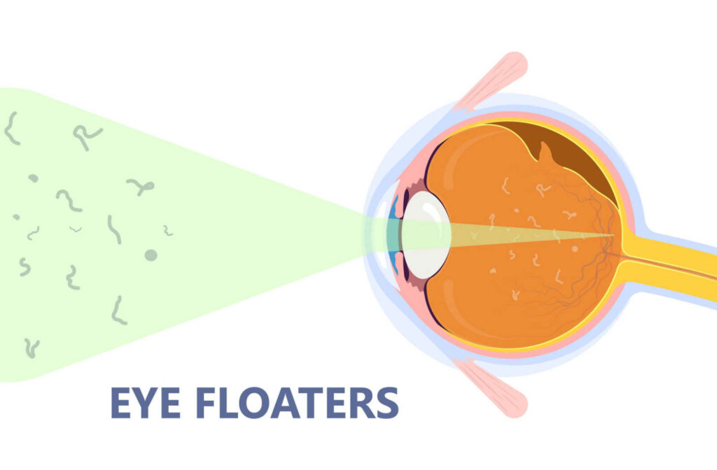 An animated recreation of the eye ball with floaters highlighted in green and Eye floaters mentioned at the bottom.