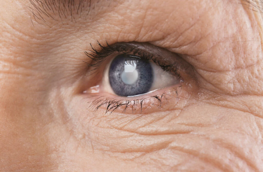 A closeup of an eye with cataract to show early signs of cataracts.