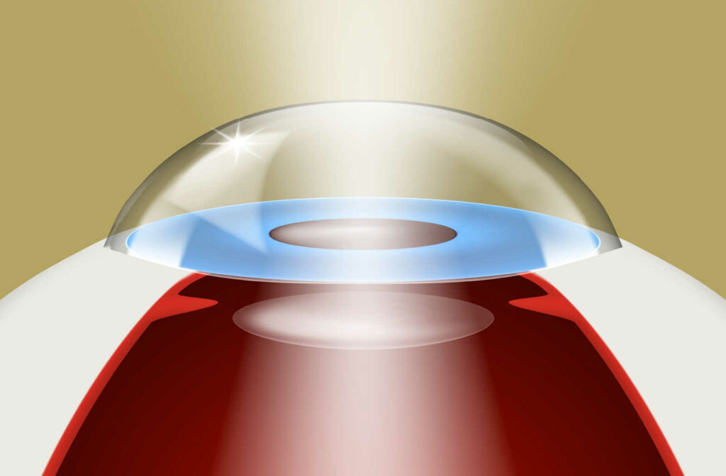 A closeup of an eye with an implanted light adjustable lens (LAL).