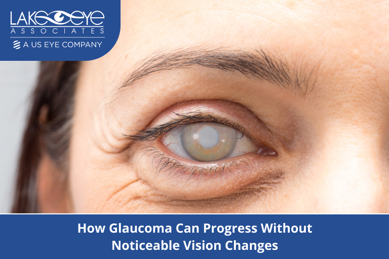 Close-up eye affected by Glaucoma